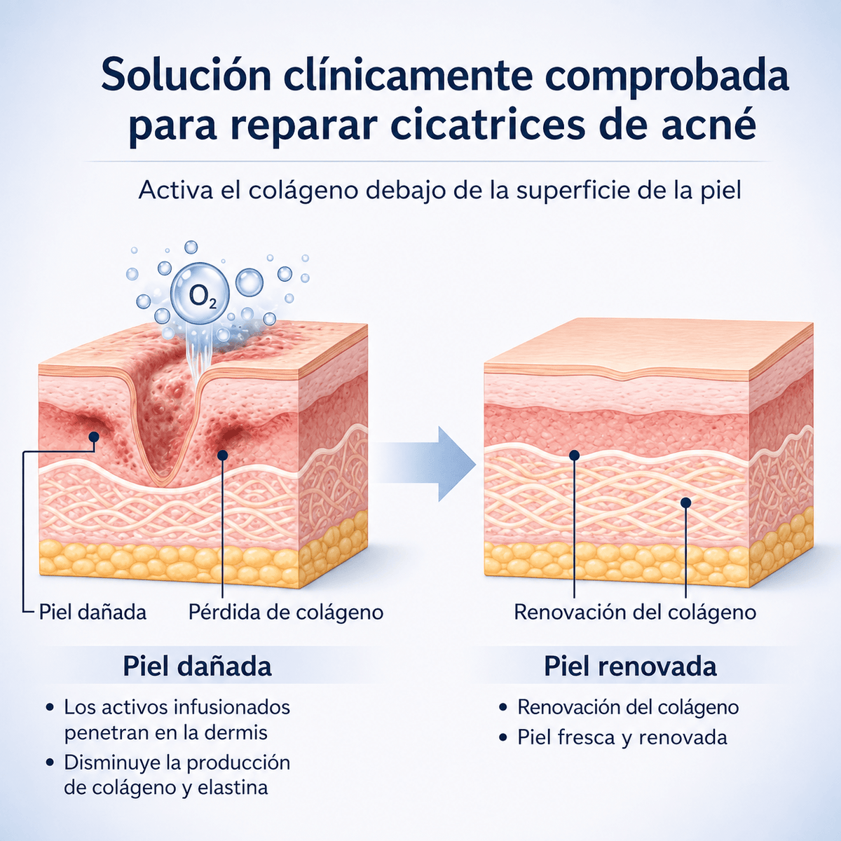 Microinfusión para el Cuidado de la Piel, Reduce las cicatrices del acné, mejora la textura de la piel