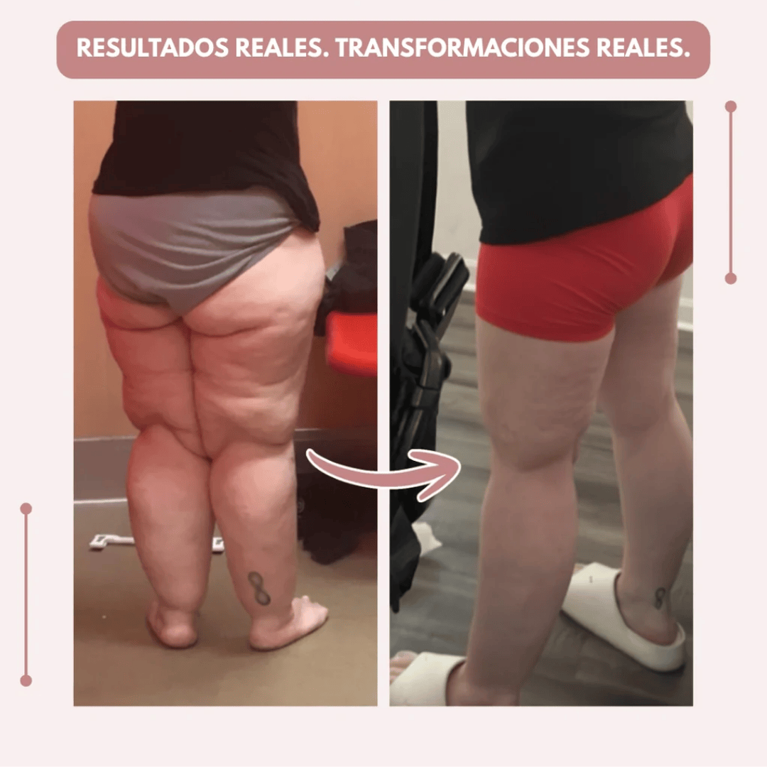 Despídete del dolor y la fatiga del lipoedema de forma natural + GUIA GRATIS