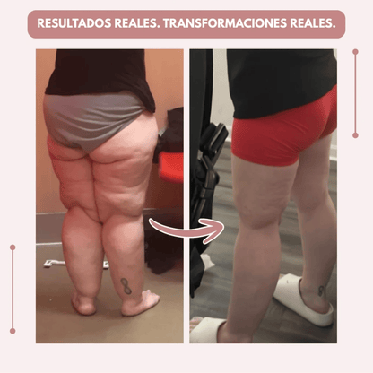 Despídete del dolor y la fatiga del lipoedema de forma natural + GUIA GRATIS
