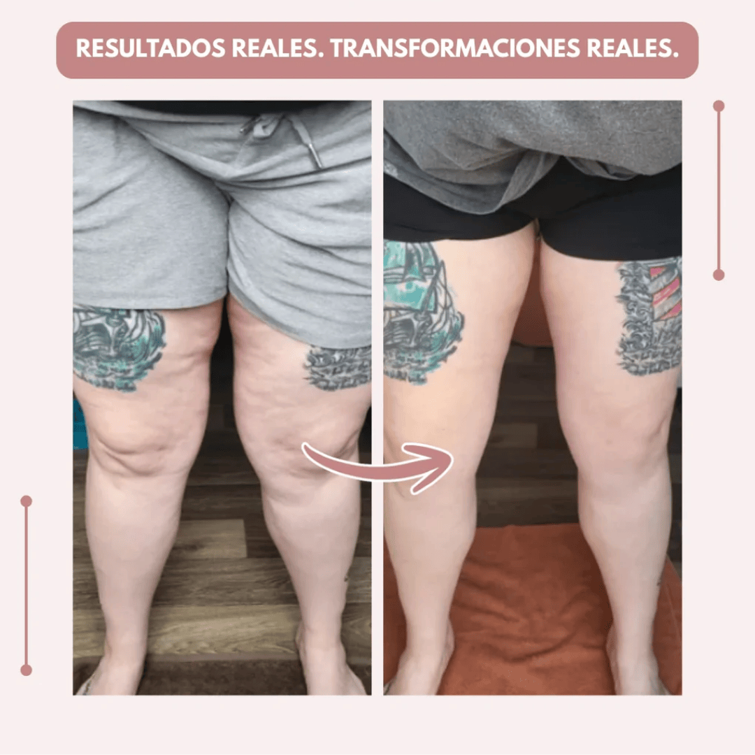 Despídete del dolor y la fatiga del lipoedema de forma natural + GUIA GRATIS