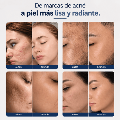Microinfusión para el Cuidado de la Piel, Reduce las cicatrices del acné, mejora la textura de la piel